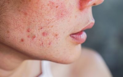 ¿Cómo eliminar las manchas de la cara?